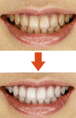 ホワイトニング